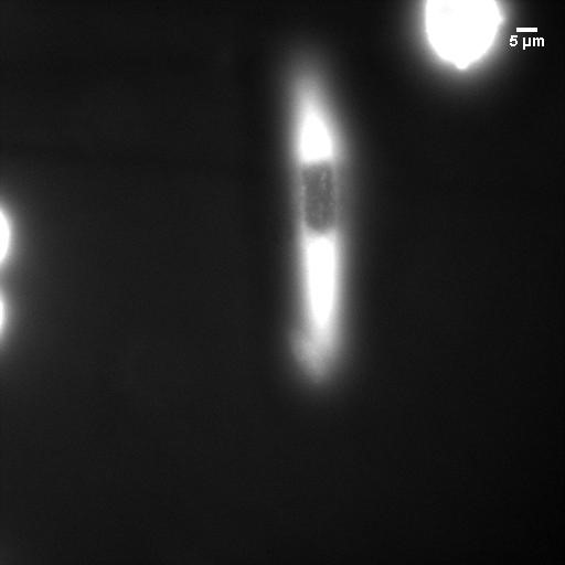 Both cells glow white. The healthy cell has a dark spot in the center where the nucleus is